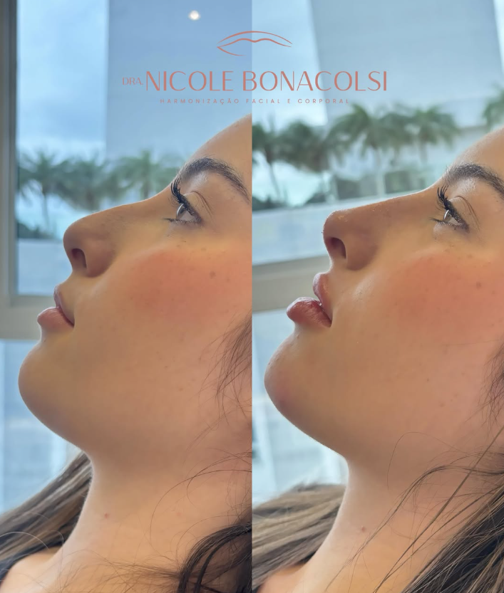 Antes e depois de harmonização facial em perfil, resultado natural na clínica Dra. Nicole Bonacolsi