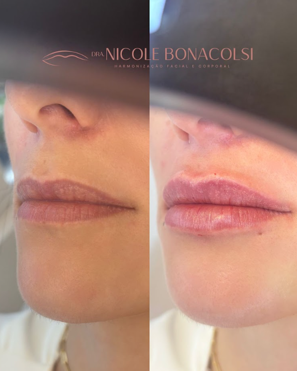 Antes e depois de preenchimento labial realizado pela Dra. Nicole Bonacolsi em Florianópolis