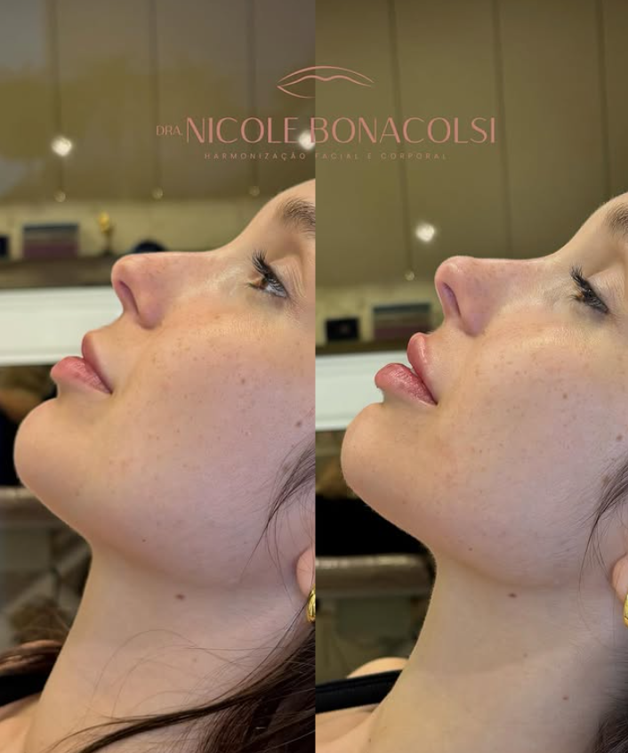 Antes e depois de contorno mandibular e harmonização facial em Florianópolis